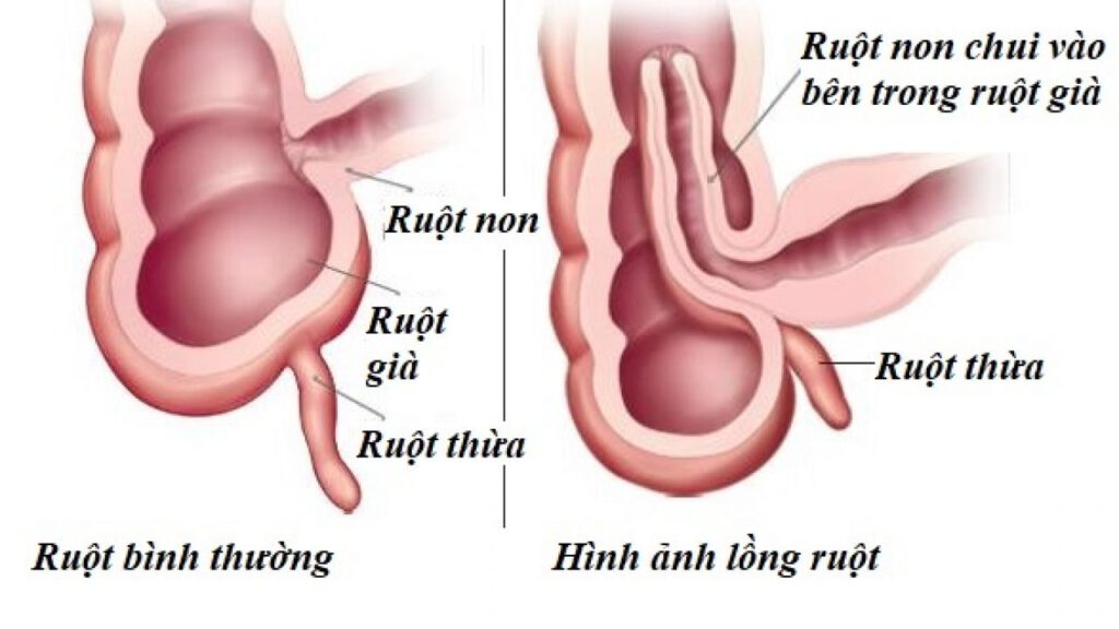 long ruot 21